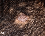 lichen planus follicularis