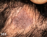 lichen planus follicularis