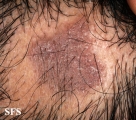 lichen planus follicularis