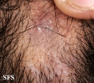 lichen planus follicularis