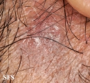 lichen planus follicularis