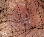 lichen planus follicularis