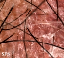 lichen planus follicularis