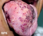 lymphangioma circumscriptum