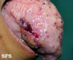 lymphangioma circumscriptum