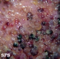 lymphangioma circumscriptum