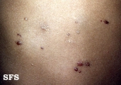 lymphangioma circumscriptum
