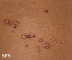 lymphangioma circumscriptum