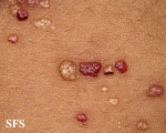 lymphangioma circumscriptum