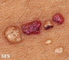 lymphangioma circumscriptum