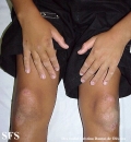 erythrokeratodermia progressive symmetric