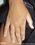 erythrokeratodermia progressive symmetric