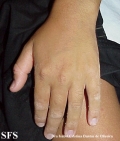 erythrokeratodermia progressive symmetric