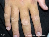erythrokeratodermia progressive symmetric