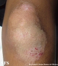 erythrokeratodermia progressive symmetric