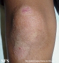 erythrokeratodermia progressive symmetric