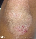 erythrokeratodermia progressive symmetric