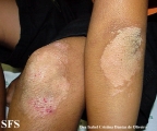 erythrokeratodermia progressive symmetric