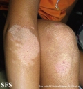 erythrokeratodermia progressive symmetric