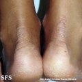 erythrokeratodermia progressive symmetric