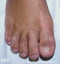 erythrokeratodermia progressive symmetric