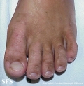 erythrokeratodermia progressive symmetric