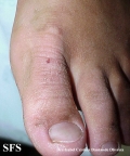 erythrokeratodermia progressive symmetric