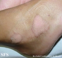 erythrokeratodermia progressive symmetric