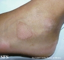 erythrokeratodermia progressive symmetric