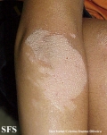 erythrokeratodermia progressive symmetric