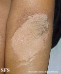 erythrokeratodermia progressive symmetric