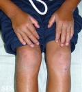 erythrokeratodermia progressive symmetric