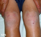 erythrokeratodermia progressive symmetric