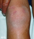 erythrokeratodermia progressive symmetric