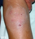 erythrokeratodermia progressive symmetric