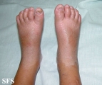 erythrokeratodermia progressive symmetric