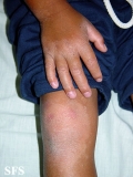 erythrokeratodermia progressive symmetric