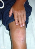 erythrokeratodermia progressive symmetric