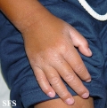 erythrokeratodermia progressive symmetric