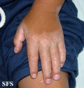 erythrokeratodermia progressive symmetric