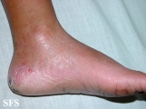 erythrokeratodermia progressive symmetric