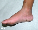 erythrokeratodermia progressive symmetric