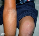 erythrokeratodermia progressive symmetric