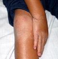 erythrokeratodermia progressive symmetric