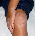 erythrokeratodermia progressive symmetric