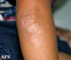 erythrokeratodermia progressive symmetric