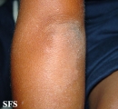 erythrokeratodermia progressive symmetric