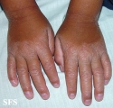 erythrokeratodermia progressive symmetric