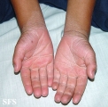 erythrokeratodermia progressive symmetric