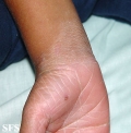 erythrokeratodermia progressive symmetric